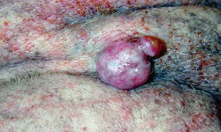 bazális sejtes tumor