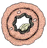 hörgők carcinoma