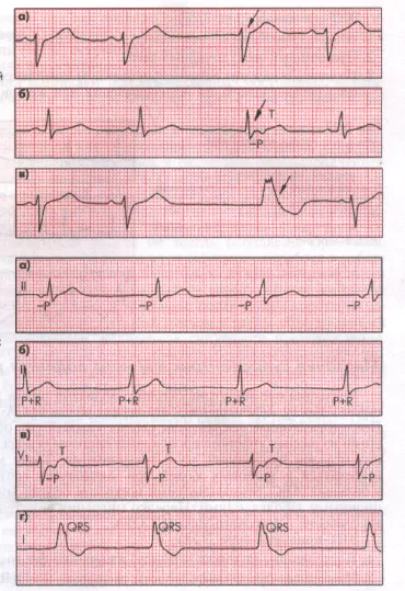 Bradyarrhythmiában sinus arrhythmia