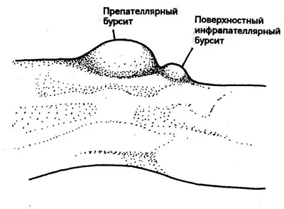 Бурсит пачи крак (коляно), лечението