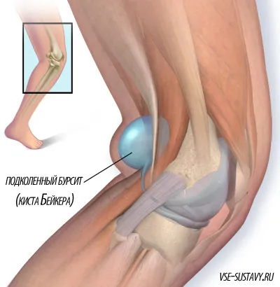 Бурсит на симптомите коляното, причините, видове