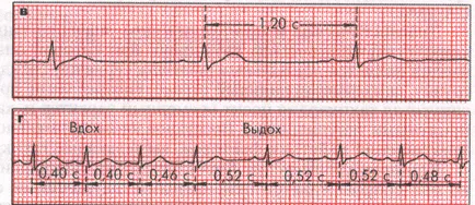 Bradyarrhythmiában sinus arrhythmia