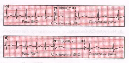 Bradyarrhythmiában sinus arrhythmia