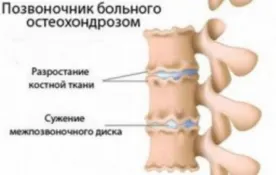 medicamente Cosudorasshiryayuschie în osteocondrozei a gâtului - comentarii pacient