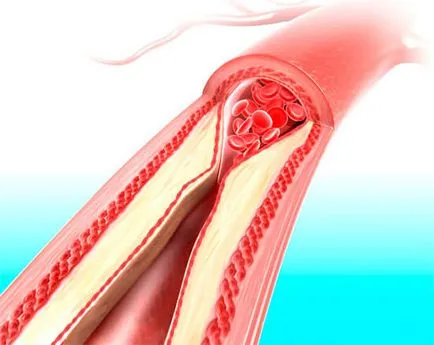 Cosudorasshiryayuschie gyógyszerek osteochondrosis a nyak - beteg véleménye