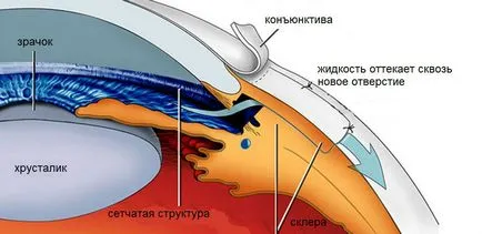 Дренаж и шънт в глаукома - видове дейности,