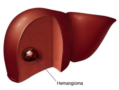 Embolizáció máj- hemangiomas beavatkozással onkológia