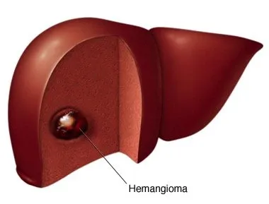 Емболизация чернодробни хемангиоми интервенционална онкологични