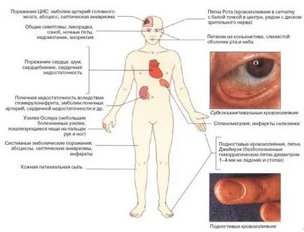 Функционално NK остра кардиомиопатия при деца, какво е то - кардиомиопатия - причини, симптоми,