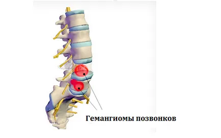 hemangiom spinării