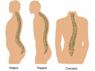 Curbura coloanei vertebrale Tratamentul, simptomele, cauzele