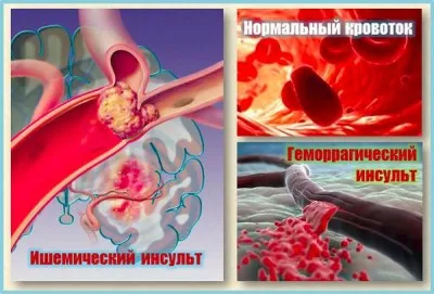 Un accident vascular cerebral asupra efectelor secundare dreapta, cât de mulți trăiesc după paralizia de emisfera dreapta