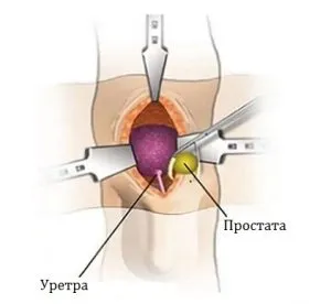Cum de a trata incontinenta urinara dupa indepartarea cancerului de prostata