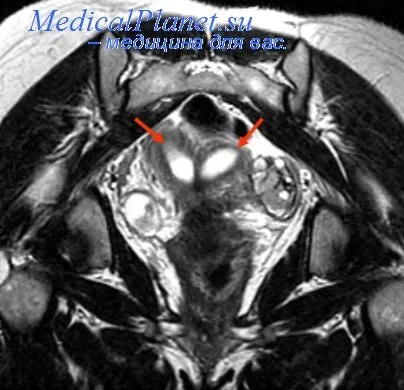 MRI на миома на матката