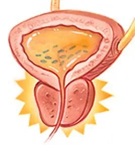 Както възпаление внимание на простатата - подуване на простатата от бързо облекчаване на симптомите и подуване