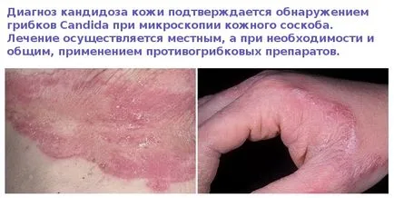 bőr candidiasis - fényképek megnyilvánulásai szájpenész