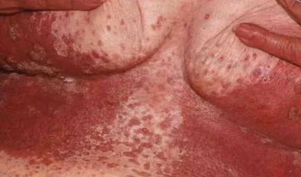 bőr candidiasis - fényképek megnyilvánulásai szájpenész