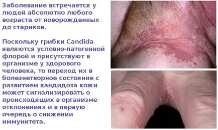 bőr candidiasis - fényképek megnyilvánulásai szájpenész