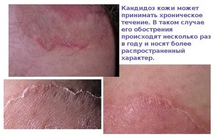 bőr candidiasis - fényképek megnyilvánulásai szájpenész