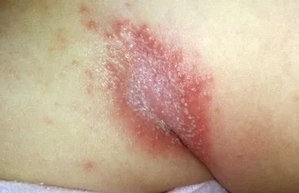 bőr candidiasis - fényképek megnyilvánulásai szájpenész