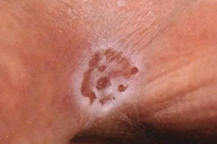 кожата кандидоза - снимки прояви на млечница