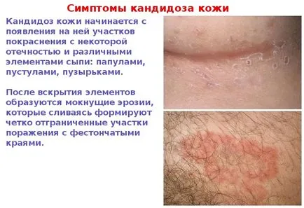 bőr candidiasis - fényképek megnyilvánulásai szájpenész