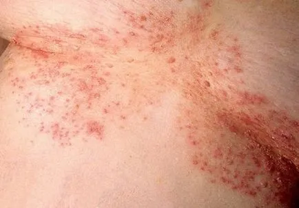 bőr candidiasis - fényképek megnyilvánulásai szájpenész