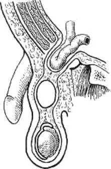 Chistul cordonului spermatic (funikulotsele) detalii despre patologia