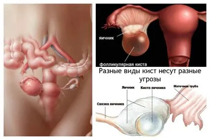 Petefészek ciszta, tünetek és hatások típusú petefészek ciszták