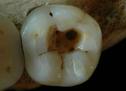 Kariesrezistentnost устойчивост на зъбния емайл кариес