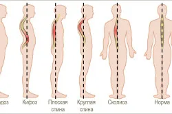 Az összetett feladat terápiát osteochondrosis sor gyakorlatok (videó)