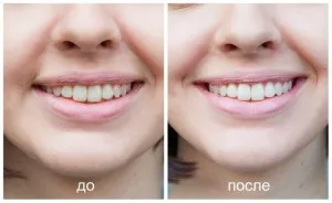 dinti cosmetice proceduri pearlsmile descriere, argumente pro și contra albire