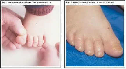 A vörös kiütés a lábát a gyermek fotó magyarázatokkal