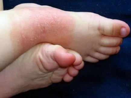 A vörös kiütés a lábát a gyermek fotó magyarázatokkal