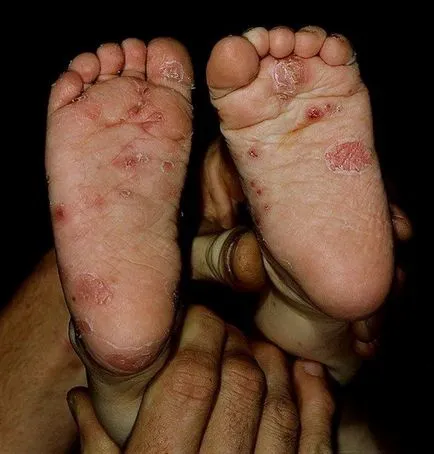 Червени обриви по краката на снимка на детето с обяснения