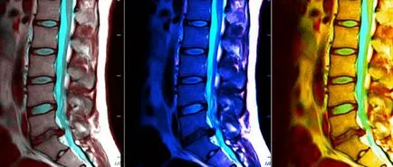 CT или MRI на гръбначния стълб