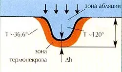 Laseri în Stomatologie - tratament stomatologic, fără o mașină de găurit