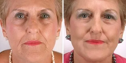 Laser lifting facial înainte și după fotografii, perioada de recuperare la domiciliu, comentarii video,