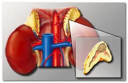 phaeochromocytoma kezelésére, tünetek enyhítésére gyógyszereket válság