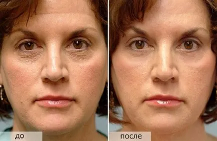 Laser lifting facial înainte și după fotografii, perioada de recuperare la domiciliu, comentarii video,