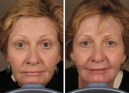 Laser lifting facial înainte și după fotografii, perioada de recuperare la domiciliu, comentarii video,