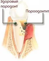лечение на периодонтит