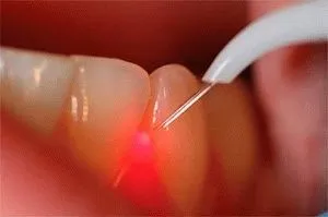 Tratamentul cu laser periodontitei