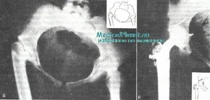 Kezelése gennyes komplikációinak arthroplastica