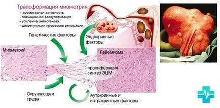 leiomiom uterin