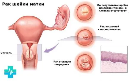 leiomiom uterin