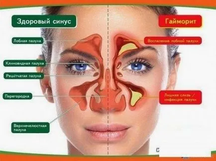 sinusitis kezelésére emberek jogorvoslatok