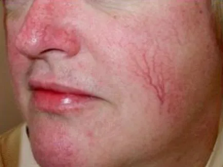 A rosacea kezelésének flash, népi jogorvoslat, fotó és videó tippeket