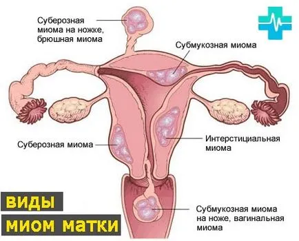 leiomiom uterin