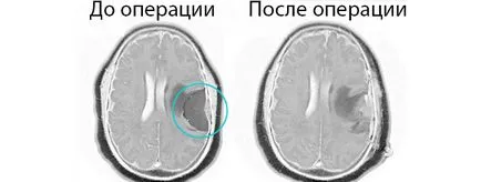 chirurgie pe creier meningiom și reabilitare